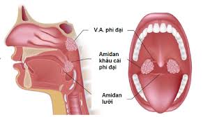 Vai Trò Của Adenoid (va) Trong Viêm Xoang Trẻ Em