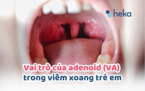 Vai Trò Của Adenoid (va) Trong Viêm Xoang Trẻ Em