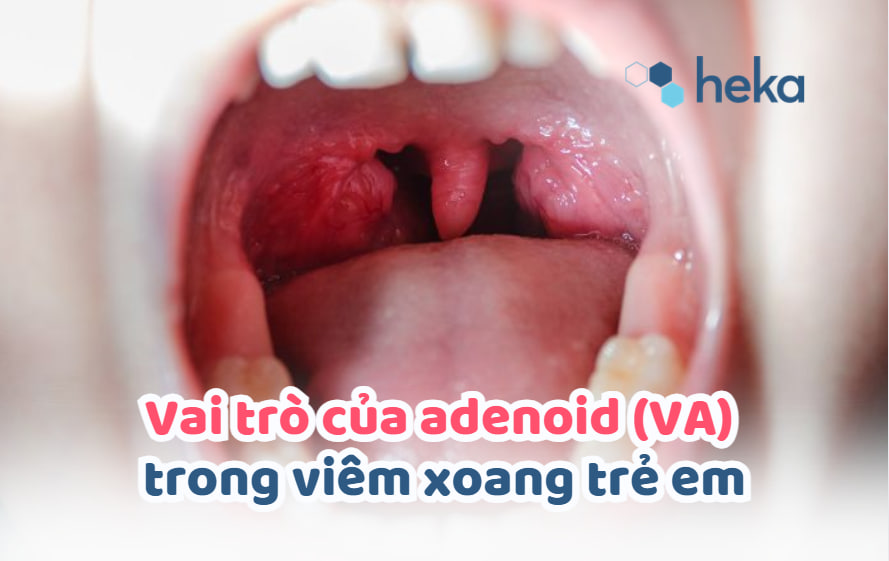 Vai Trò Của Adenoid (va) Trong Viêm Xoang Trẻ Em