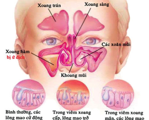 Những Biến Chứng Nguy Hiểm Của Viêm Xoang Không điều Trị