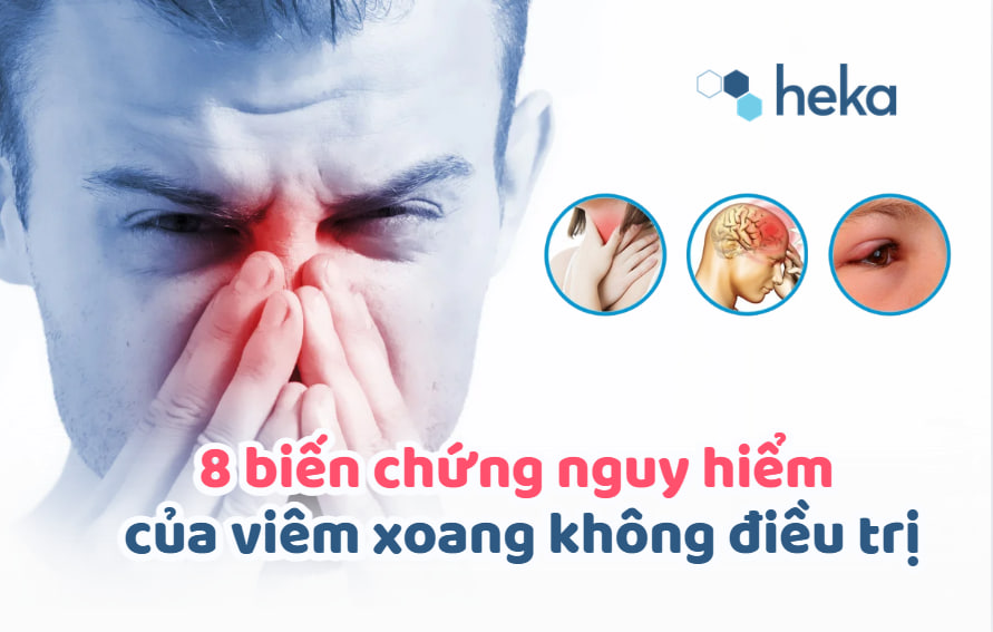 8 Biến Chứng Nguy Hiểm Của Viêm Xoang Không điều Trị