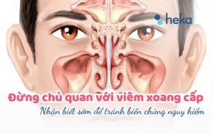 Đừng Chủ Quan Với Viêm Xoang Cấp – Nhận Biết Sớm để Tránh Biến Chứng Nguy Hiểm