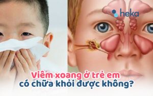Viêm Xoang ở Trẻ Em Có Chữa Khỏi được Không?