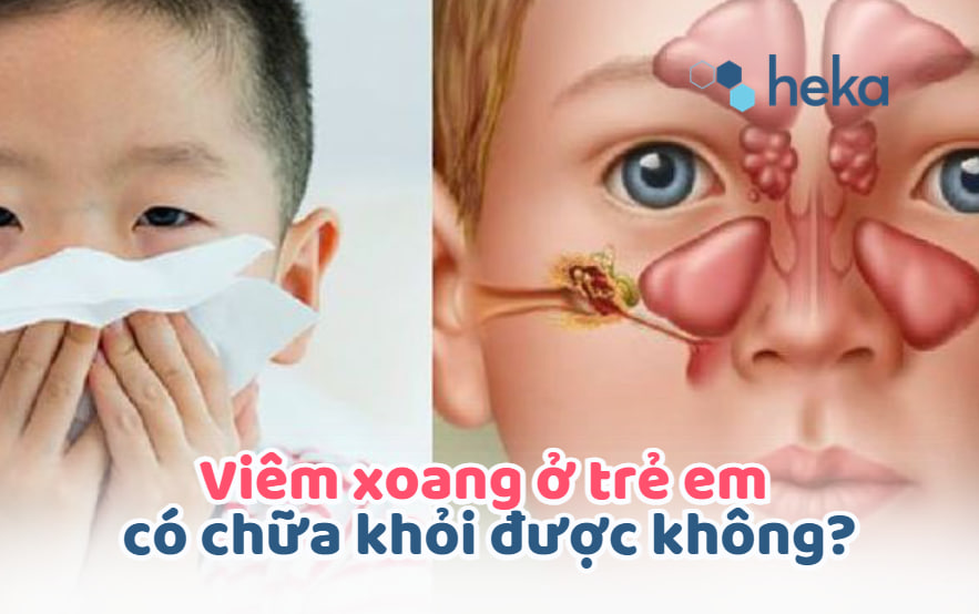 Viêm Xoang ở Trẻ Em Có Chữa Khỏi được Không?