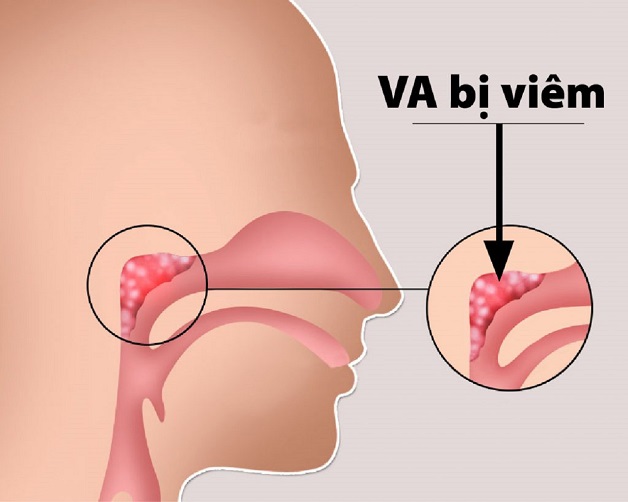 Viêm VA là gì? Tìm hiểu về viêm VA ở trẻ | TCI Hospital