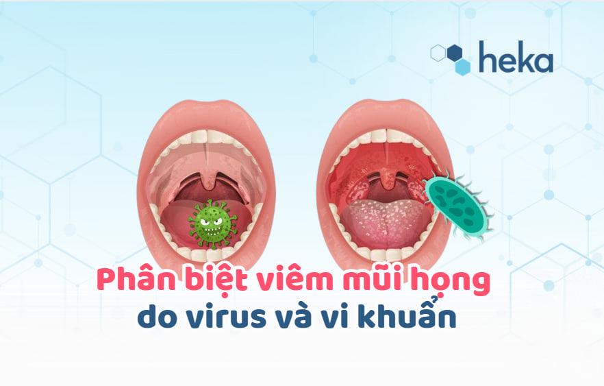 Phân Biệt Viêm Mũi Họng Do Virus Hoặc Vi Khuẩn